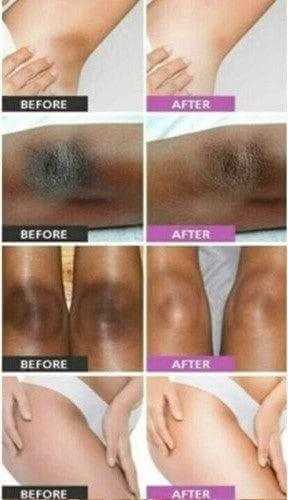 Before and after results of using Dark Inner Thighs & Armpits Solution Serum for skin lightening.