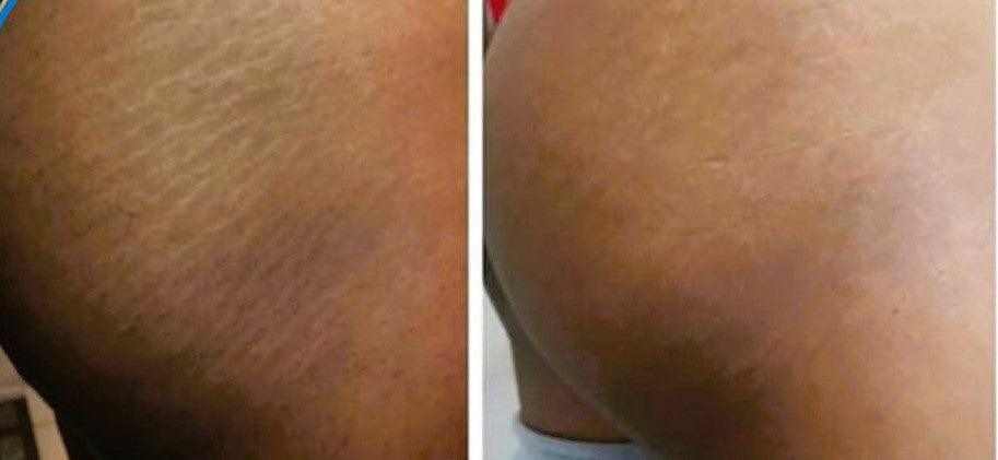 Before and after images showing reduced appearance of stretch marks on skin after using stretch mark oil.